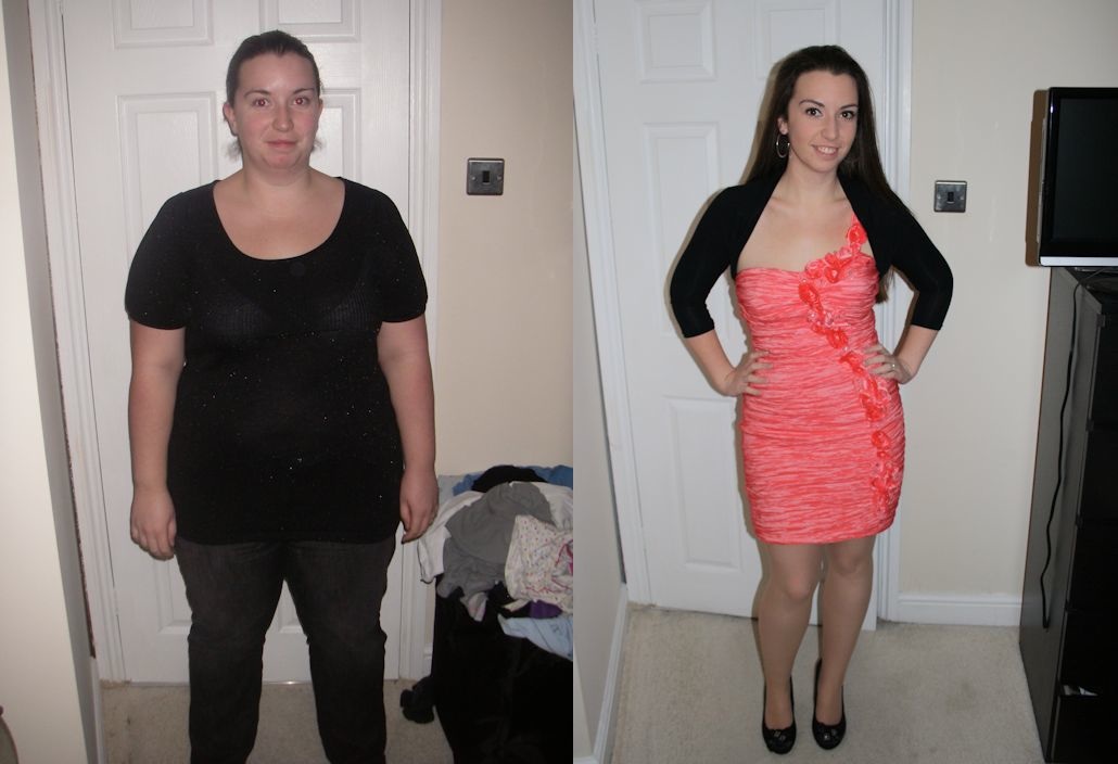 gastric sleeve story