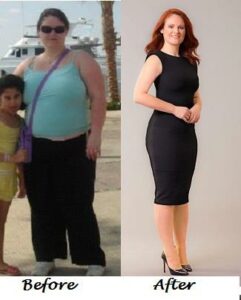 angela_gastric_bypass